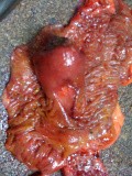 Ascending Colon Intussusception due to a Adenocarcinoma (6 of 6)