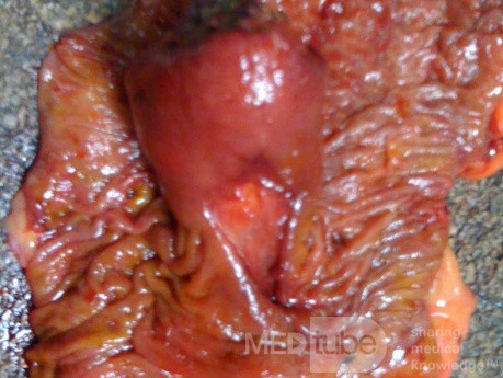 Ascending Colon Intussusception due to a Adenocarcinoma (6 of 6)