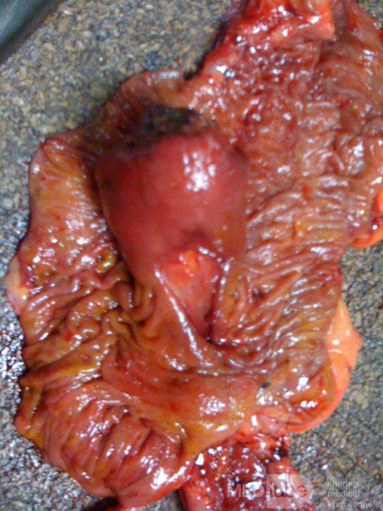 Ascending Colon Intussusception due to a Adenocarcinoma (6 of 6)