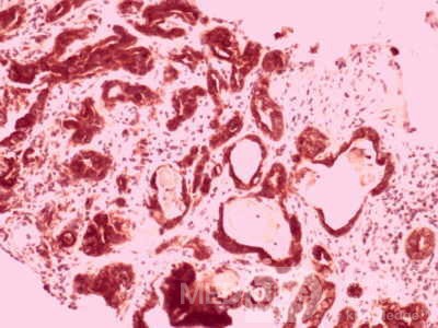 Gallbladder Adenocarcinoma and litiasis (10 of 13)