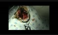Palatoplasty