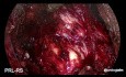 Laparoscopic Radical Prostatectomy Retzius Sparing