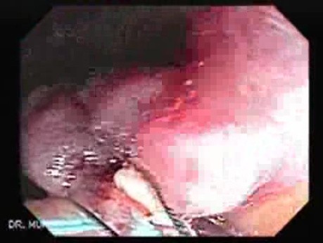 Huge Mass Of The Descending Colon (14 of 25)