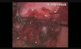 Total Laparoscopic Hysterectomy with BSO in Endometriosis