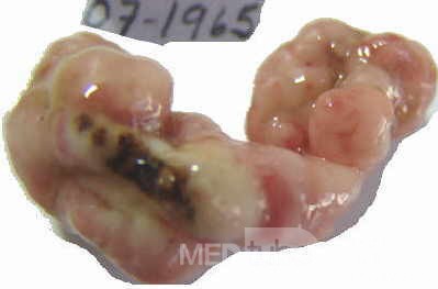Colonoscopic Polypectomy (24 of 29)