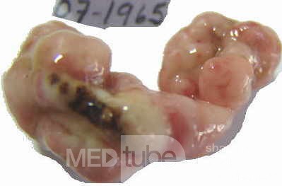 Colonoscopic Polypectomy (24 of 29)