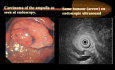 Tumours of the Pancreas