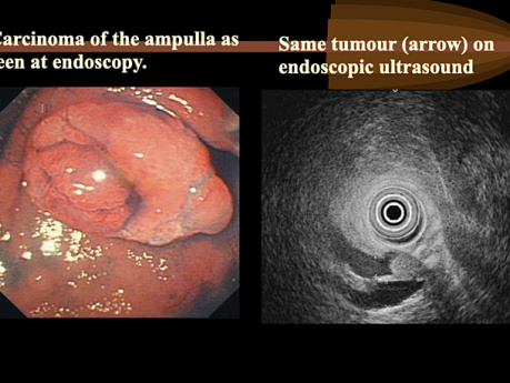 Tumours of the Pancreas