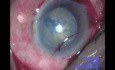 Cataract Surgery - Part 1/2