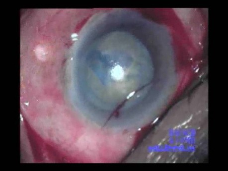 Cataract Surgery - Part 1/2