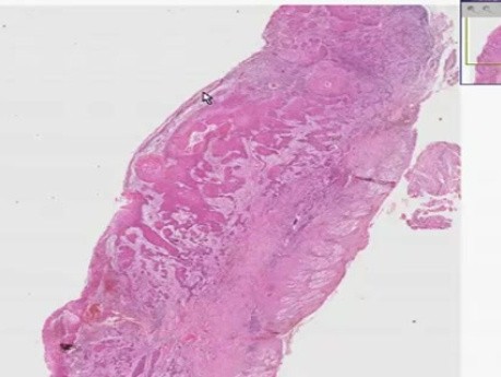 Squamous cell carcinoma