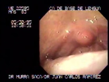 Carcinoma of the Base of the Tongue