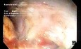 ESD of a Huge 11x5 cm LST-G Mixed Type in Frailty Syndrome Patient