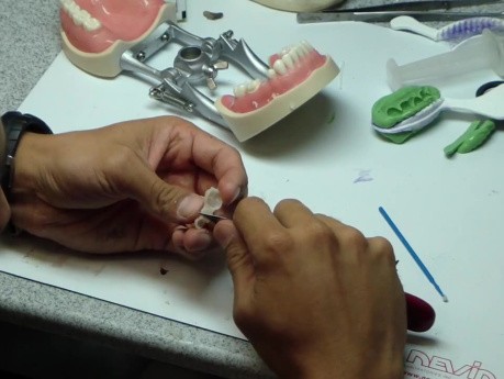 Bisacryl Adjustment With Blade