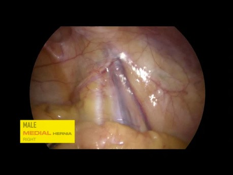 Examples of Groin Anatomy in Various Patients and Hernia Types