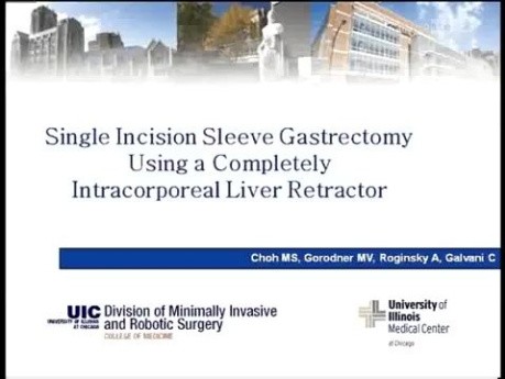 SILS Sleeve Stomach Excision With An Intracorporeal Retraction Of The Liver.