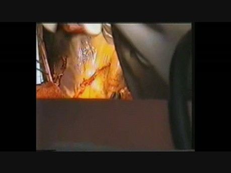 Bilateral Internal Mammary Artery Coronary Artery Grafting Using Y-Graft Technique