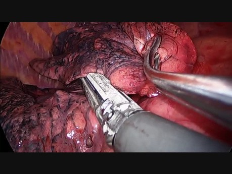 Subxiphoid Uniportal VATS Bilateral Surgery