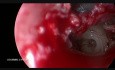 Endoscopic Two-Handed Stapes Surgery