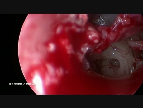 Endoscopic Two-Handed Stapes Surgery