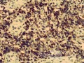 Non-Hodking Lymphoma B Cells. MALT (mucosa associated lymphoid tissue) (5 of 7)
