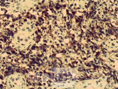 Non-Hodking Lymphoma B Cells. MALT (mucosa associated lymphoid tissue) (5 of 7)