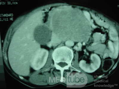 Gastric Ulcer with Gastrocolic fistula due to a Zollinger-
 Ellison Syndrome (26of 33)