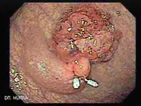 Multilobulated Gastric Polyp (9 of 20)