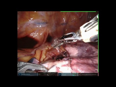 Left Upper Lobe Lung Cancer