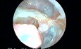 Cavity in the temporal bone after modified radical mastoidectomy