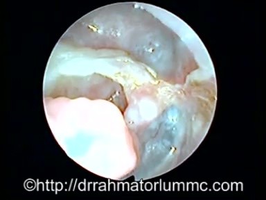 Cavity in the temporal bone after modified radical mastoidectomy