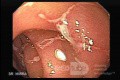 Multiple Duodenal Erosions due to Salmonella Enteritis (5 of 5)