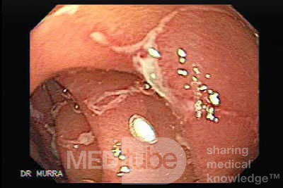 Multiple Duodenal Erosions due to Salmonella Enteritis (5 of 5)