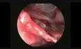 Endoscopic Identification of the Sphenopalatine Artery in the Nose and coagulation