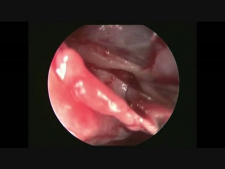 Endoscopic Identification of the Sphenopalatine Artery in the Nose and coagulation