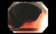 Colonoscopy Channel - Resection of A Giant Colon Polyp