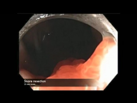 Colonoscopy Channel - Resection of A Giant Colon Polyp