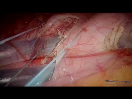 Laparoscopic Resection of Two Gastric Tumors