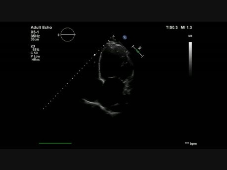 DCM with Apical Thrombus