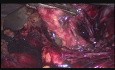 Difficult laparoscopic cholecystectomy