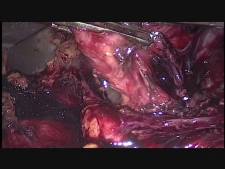 Difficult laparoscopic cholecystectomy