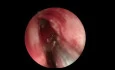 Complete Left Endoscopic Sinus Surgery 3 - Almost Unedited