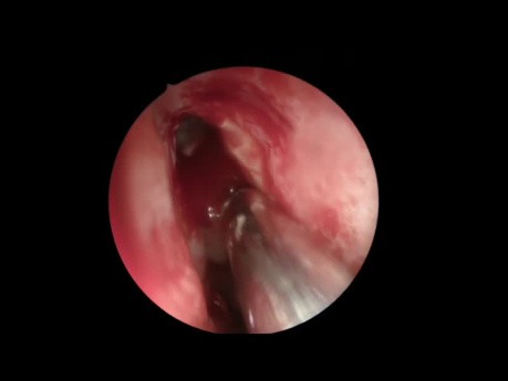 Complete Left Endoscopic Sinus Surgery 3 - Almost Unedited
