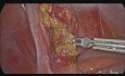 Laparoscopic Appendecectomy for Acute Appendicitis Secondary to Worm Infestation