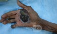 Acral Melanoma