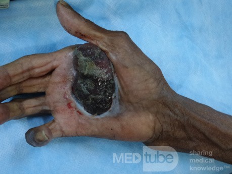 Acral Melanoma