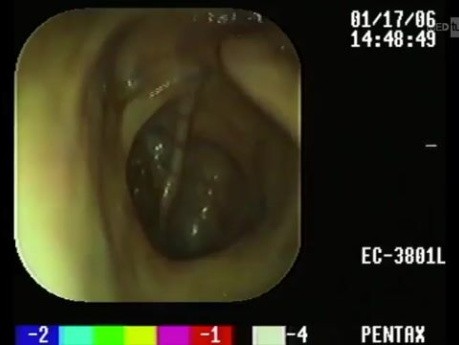 Cystic Intestinal Pneumatosis - Colonoscopy