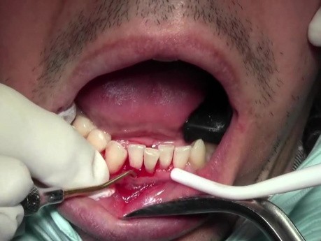 Tunneling Technique - Gingival Grafting #26-25-24