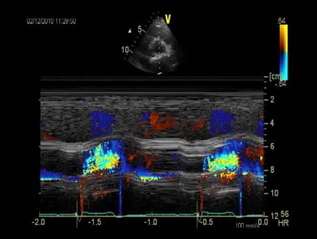 Aortic Paraprosthetic Leak