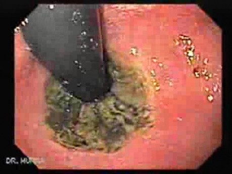 The Black Esophagus - Borders of the Changed Mucosa, Retroflexed View